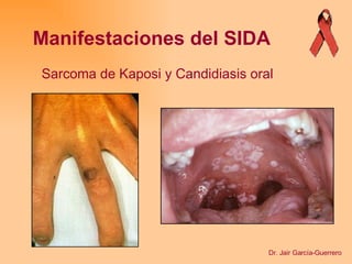 Manifestaciones del SIDA Sarcoma de Kaposi y Candidiasis oral Dr. Jair García-Guerrero 