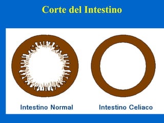Corte del Intestino 
 