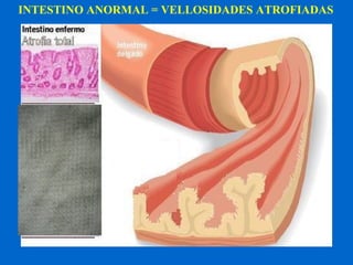 INTESTINO ANORMAL = VELLOSIDADES ATROFIADAS 
 