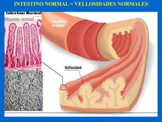 INTESTINO NORMAL = VELLOSIDADES NORMALES 