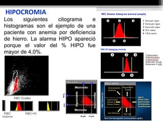 HIPOCROMIA
Los siguientes citograma e
histogramas son el ejemplo de una
paciente con anemia por deficiencia
de hierro. La alarma HIPO apareció
porque el valor del % HIPO fue
mayor de 4,0%.
 