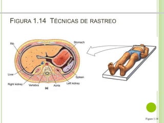 FIGURA 1.14 TÉCNICAS DE RASTREO 
Dr. Jose A Carde-Serrano 
Figure 1.14 
 