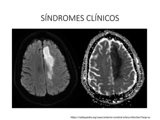 CLASE 1 - ENFERMEDAD VASCULAR CEREBRAL 2024-II.pptx