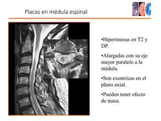 Placas en médula espinal
•Hiperintesas en T2 y
DP.
•Alargadas con su eje
mayor paralelo a la
médula.
•Son exentricas en el
plano axial.
•Pueden tener efecto
de masa.
 