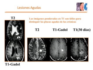 Lesiones Agudas
T1(30 días)
T1-Gadol
T2
T2
T1-Gadol
Las imágenes ponderadas en T1 son útiles para
distinguir las placas agudas de las crónicas
 
