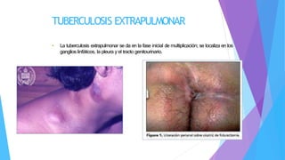 TUBERCULOSIS EXTRAPULMONAR
• La tuberculosis extrapulmonar se da en la fase inicial de multiplicación; se localiza en los
ganglios linfáticos, la pleura y el tracto genitourinario.
 