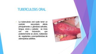 TUBERCULOSIS ORAL
• La tuberculosis oral suele tener un
carácter secundario; afecta
principalmente a glándulas salivales,
lengua, encía y paladar; se inicia
con una induración, que
posteriormente se ulcera, rodéandoe
de vegetantes y acompañándose de
adenopatías satélites.
 