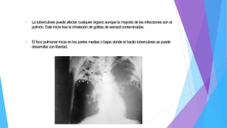 • La tuberculosis puede afectar cualquier órgano aunque la mayoría de las infecciones son al
pulmón. Este inicia tras la inhalación de gotitas de aerosol contaminadas.
• El foco pulmonar inicia en las partes medias o bajas donde el bacilo tuberculosis se puede
desarrollarcon libertad.
 