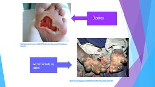 Acortamiento delos
dedos
Úlceras
http://veracruzinforma.com.mx/2011/01/la-lepra-en-mexico-una-enfermedad-aun-
presente/
http://maruen87.blogspot.com/2009/01/lepra-enfermedad-de-los-pobres.html
 