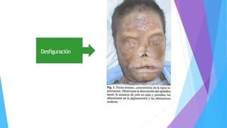 Desfiguración
Chimenos-KüstnerE, Pascual-CruzM,Piñol-DansisC,Viñals-IglesiasH,RodríguezdeRivera-CampilloME,López-López
J.Lepromatousleprosy:Areviewandcasereport.MedOralPatolOralCirBucal2006;11:E474-9.
©MedicinaOralS. L.C.I.F.B96689336- ISSN1698-6946
 