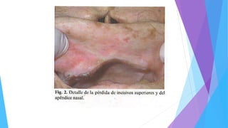 Chimenos-KüstnerE,Pascual-CruzM,Piñol-DansisC,Viñals-IglesiasH,RodríguezdeRivera-CampilloME,López-LópezJ.Lepromatousleprosy:A
reviewandcasereport.MedOralPatolOralCirBucal2006;11:E474-9.©MedicinaOralS.L.C.I.F.B96689336- ISSN1698-6946
 