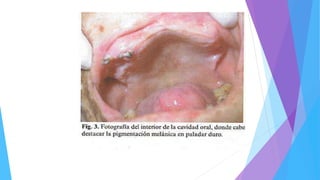 Chimenos-KüstnerE,Pascual-CruzM,Piñol-DansisC,Viñals-IglesiasH,RodríguezdeRivera-CampilloME,López-LópezJ.Lepromatous
leprosy:Areviewandcasereport.MedOralPatolOralCirBucal2006;11:E474-9.©MedicinaOralS.L.C.I.F.B96689336- ISSN1698-6946
 