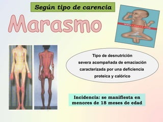 Tipo de desnutrición
severa acompañada de emaciación
caracterizada por una deficiencia
proteica y calórico
Incidencia: se manifiesta en
menores de 18 meses de edad
Según tipo de carencia
 