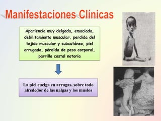 La piel cuelga en arrugas, sobre todo
alrededor de las nalgas y los muslos
Apariencia muy delgada, emaciada,
debilitamiento muscular, perdida del
tejido muscular y subcutáneo, piel
arrugada, pérdida de peso corporal,
parrilla costal notoria
 