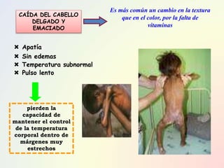  Apatía
 Sin edemas
 Temperatura subnormal
 Pulso lento
Es más común un cambio en la textura
que en el color, por la falta de
vitaminas
pierden la
capacidad de
mantener el control
de la temperatura
corporal dentro de
márgenes muy
estrechos
CAÍDA DEL CABELLO
DELGADO Y
EMACIADO
 
