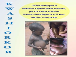 Trastorno dietético grave de
malnutrición, el aporte de calorías es adecuado,
pero el de proteínas insuficientes
Incidencia: aumenta después de los 18 meses,
Hasta los 3 a 4 años de edad
 