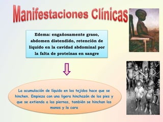 La acumulación de líquido en los tejidos hace que se
hinchen. Empieza con una ligera hinchazón de los pies y
que se extienda a las piernas, también se hinchan las
manos y la cara
Edema: engañosamente graso,
abdomen distendido, retención de
liquido en la cavidad abdominal por
la falta de proteínas en sangre
 