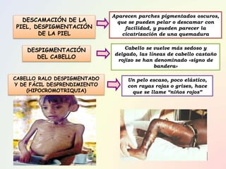 Aparecen parches pigmentados oscuros,
que se pueden pelar o descamar con
facilidad, y pueden parecer la
cicatrización de una quemadura
Cabello se vuelve más sedoso y
delgado, las líneas de cabello castaño
rojizo se han denominado «signo de
bandera»
Un pelo escaso, poco elástico,
con rayas rojas o grises, hace
que se llame “niños rojos”
DESCAMACIÓN DE LA
PIEL, DESPIGMENTACIÓN
DE LA PIEL
DESPIGMENTACIÓN
DEL CABELLO
CABELLO RALO DESPIGMENTADO
Y DE FÁCIL DESPRENDIMIENTO
(HIPOCROMOTRIQUIA)
 