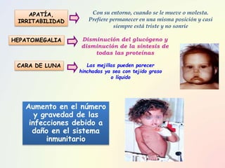 Con su entorno, cuando se le mueve o molesta.
Prefiere permanecer en una misma posición y casi
siempre está triste y no sonríe
Las mejillas pueden parecer
hinchadas ya sea con tejido graso
o líquido
Disminución del glucógeno y
disminución de la síntesis de
todas las proteínas
APATÍA,
IRRITABILIDAD
HEPATOMEGALIA
CARA DE LUNA
Aumento en el número
y gravedad de las
infecciones debido a
daño en el sistema
inmunitario
 