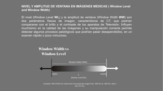 NIVEL Y AMPLITUD DE VENTANA EN IMÁGENES MEDICAS ( Window Level
and Window Width)
El nivel (Window Level WL) y la amplitud de ventana (Window Width WW) son
dos parámetros físicos de imagen, característicos de CT, que podrían
compararse con el brillo y el contraste de los aparatos de Televisión. Influyen
muchísimo en la calidad de las imágenes y su manipulación correcta permite
detectar algunos procesos patológicos que podrían pasar desapercibidos, en un
examen rápido o poco minucioso.
 