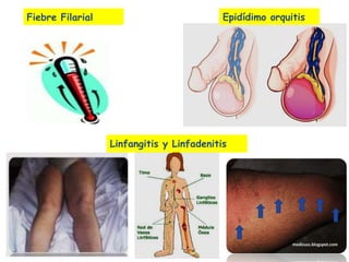 Linfangitis Reticular Clase 11 filariasis linfatica | PPTX