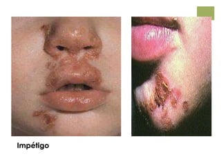 Impétigo
 