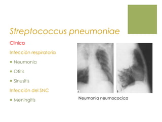 Streptococcus pneumoniae
Clinica
Infección respiratoria
 Neumonia
 Otitis
 Sinusitis
Infección del SNC
 Meningitis Neumonia neumococica
 