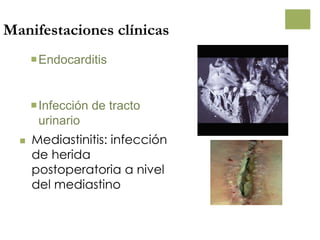 Manifestaciones clínicas
Endocarditis
Infección de tracto
urinario
 Mediastinitis: infección
de herida
postoperatoria a nivel
del mediastino
 