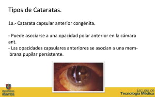 Tipos de Cataratas.
1a.- Catarata capsular anterior congénita.

- Puede asociarse a una opacidad polar anterior en la cáma...