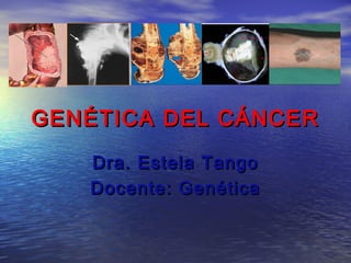 GENÉTICA DEL CÁNCERGENÉTICA DEL CÁNCER
Dra. Estela TangoDra. Estela Tango
Docente: GenéticaDocente: Genética
 