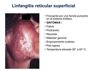 Linfangitis Reticular Clase 13 - ANATOMIA Sistema linfatico.pptx