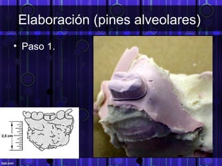 Elaboración (pines alveolares)
• Paso 1.
 