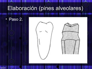 Elaboración (pines alveolares)
• Paso 2.
 