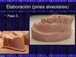 Elaboración (pines alveolares)
• Paso 5.
 