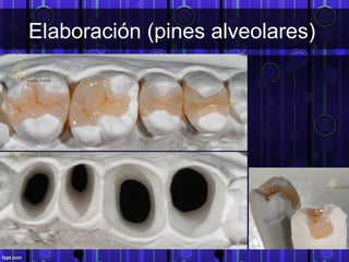Elaboración (pines alveolares)
 