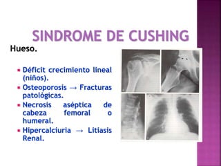 Hueso.
 Déficit crecimiento lineal
(niños).
 Osteoporosis → Fracturas
patológicas.
 Necrosis aséptica de
cabeza femoral o
humeral.
 Hipercalciuria → Litiasis
Renal.
 