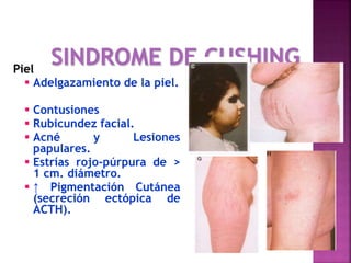 Piel
 Adelgazamiento de la piel.
 Contusiones
 Rubicundez facial.
 Acné y Lesiones
papulares.
 Estrías rojo-púrpura de >
1 cm. diámetro.
 ↑ Pigmentación Cutánea
(secreción ectópica de
ACTH).
 