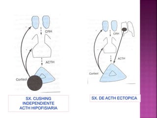 SX. CUSHING
INDEPENDIENTE
ACTH HIPOFISIARIA
SX. DE ACTH ECTOPICA
 