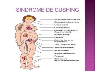 SINDROME DE CUSHING
 