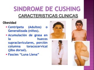 Obesidad
 Centrípeta (Adultos) o
Generalizada (niños).
 Acumulación de grasa en
la huecos
supraclaviculares, porción
columna toracocervical
(jiba dorsal).
 Fascies “Luna Llena”
CARACTERISTICAS CLINICAS
 