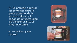 •3.- Se procede a revisar
los contactos entre la
parte posterior de la
protesis inferior y la
región de la tuberosidad
de la superior. Esto es
muy importante
•4.-Se realiza ajuste
oclusal
 