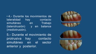• 4.- Durante los movimientos de
lateralidad hay contacto
simultáneo en Trabajo
(laterotrusión) y en balance
(mediotrusión).
5.- Durante el movimiento de
protrusiva hay contacto
simultáneo en el sector
anterior y posterior.
 