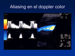 Aliasing en el doppler color
 