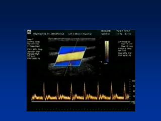 PRINCIPIOS BASICOS DE LA ECOGRAFÍA DOPPLER