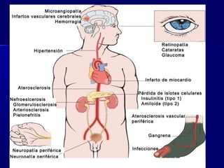 Microangiopatía
Infartos vasculares cerebrales
Hemorragia
Retinopatía
Cataratas
Glaucoma
Hipertensión
Aterosclerosis
Infarto de miocardio
Nefroeslcerosis
Glomerulosclerosis
Arteriosclerosis
Pielonefritis
Neuropatía periférica
Neuropatía periférica
Pérdida de islotes celulares
Insulinitis (tipo 1)
Amiloide (tipo 2)
Aterosclerosis vascular
periférica
Gangrena
Infecciones
 