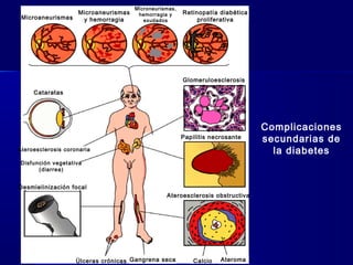 Complicaciones
secundarias de
la diabetes
Desmielinización focal
Disfunción vegetativa
(diarrea)
Ateroesclerosis coronaria
Cataratas
Microaneurismas
Microaneurismas
y hemorragia
Microneurismas,
hemorragia y
exudados
Retinopatía diabética
proliferativa
Glomeruloesclerosis
Papilitis necrosante
Ateroesclerosis obstructiva
Úlceras crónicas Gangrena seca Calcio Ateroma
 