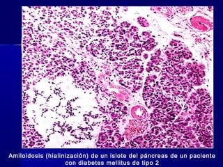 Amiloidosis (hialinización) de un islote del páncreas de un paciente
con diabetes mellitus de tipo 2
 