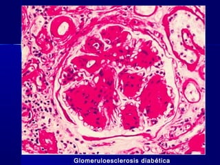 Glomeruloesclerosis diabética
 