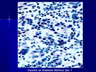 Insulitis en Diabetes Mellitus tipo 1
 