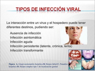 La interacción entre un virus y el hospedero puede tener
diferentes destinos, pudiendo ser:
  Ausencia de infección
  Infección asintomática
  Infección aguda
  Infección persistente (latente, crónica, lenta)
  Infección transformante



 Figura A. Gingivoestomatitis herpética B. Herpes labial C. Panadizo
 herpético D. Herpes simplex tipo 1 de localización genital
 